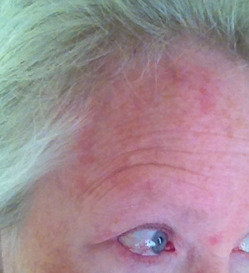 Day
                    One of Shingles or Herpes Zoster Virus rash on
                    forehead