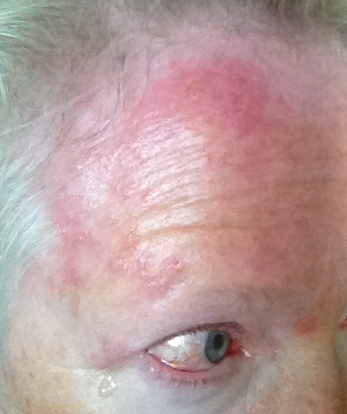 Day Two of Shningles Herpes Zoster Virus
                      Rash