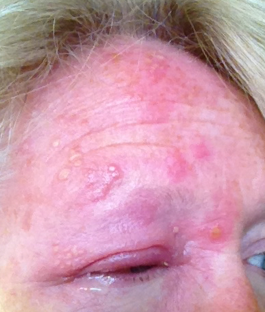 Day Four of Shingles or herpes Zoster Virus
                    in the eye