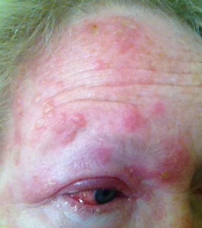 Day Five ocular shingles ophthalmic shingle
                    symptoms