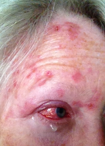 Day Seven of Herpes Zoster Virus, Shingles in
                      forehead and eye.